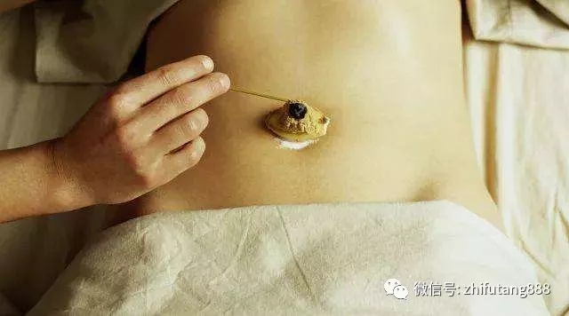 蕲艾灸肚脐眼上到底能不能做艾灸呢