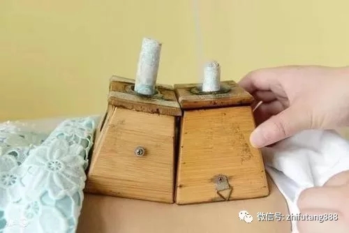 蕲艾灸肚脐眼上到底能不能做艾灸呢