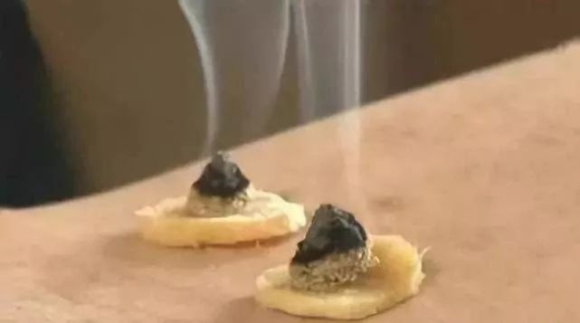 隔蒜灸:将新鲜的大蒜捣成蒜泥,做成厚约0.